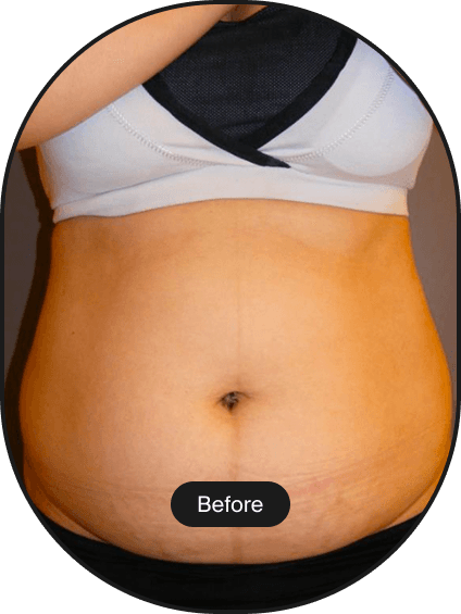 LIPOcel Tightening Treatment