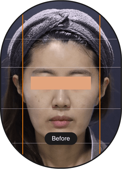 POTENZA DIA Tip, Sagging Treatment