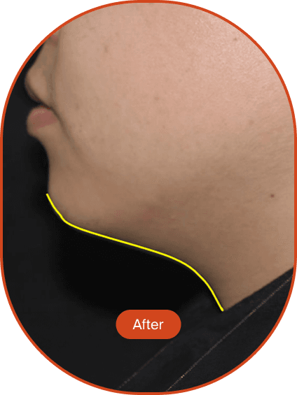 Ultracel Q+ HIFU