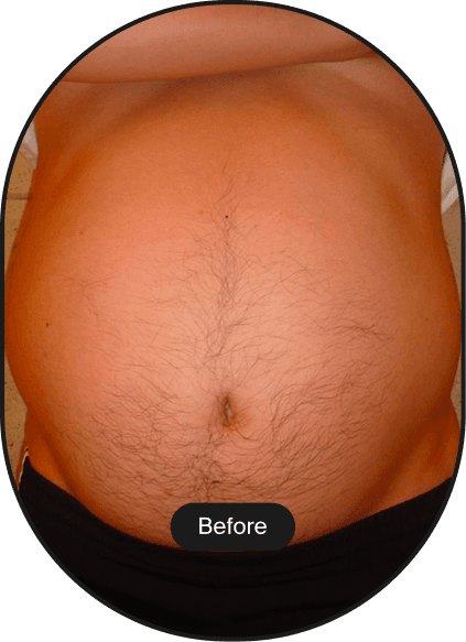 LIPOcel Tightening Treatment