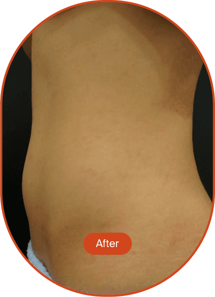 LIPOcel Tightening Treatment