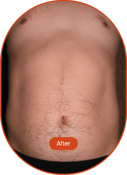 LIPOcel Tightening Treatment