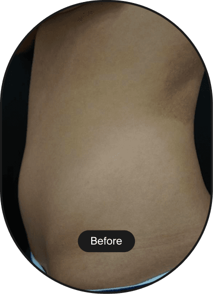 LIPOcel Tightening Treatment