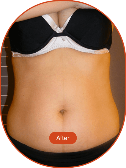 LIPOcel Tightening Treatment