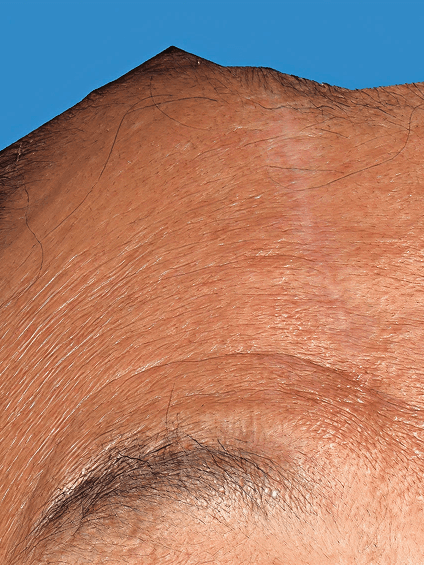 Rejruan Treatment