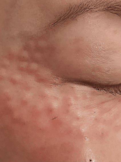 Rejruan Treatment