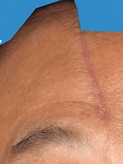 Rejruan Treatment