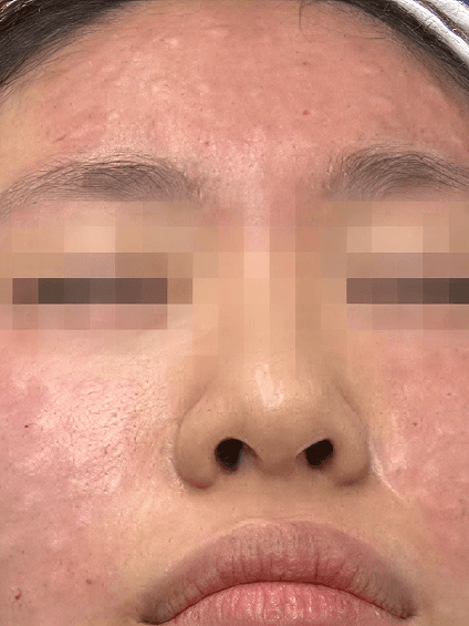 Rejruan Treatment